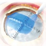 duraseal sellador dural en guadalajara | IGEA